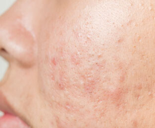 Akneye Eğilimli Ciltler