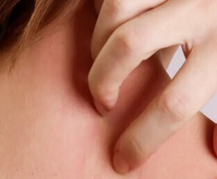 Atopiye Eğilimli Ciltler