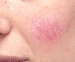 Kızarık - Hassas Ciltler