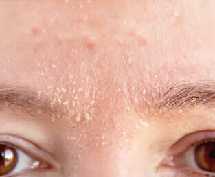 Kuruluk – Hassasiyet