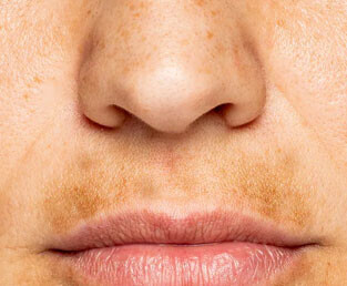 Leke - Ton Farklılıkları 