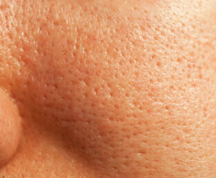 Siyah Nokta – Gözenek