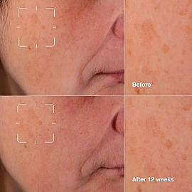 Clinique Even Better Clinical Radical Dark Spot - Leke Karşıtı Serum 30ml - 4
